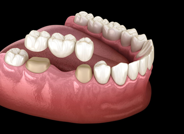 Dental Bridges portland