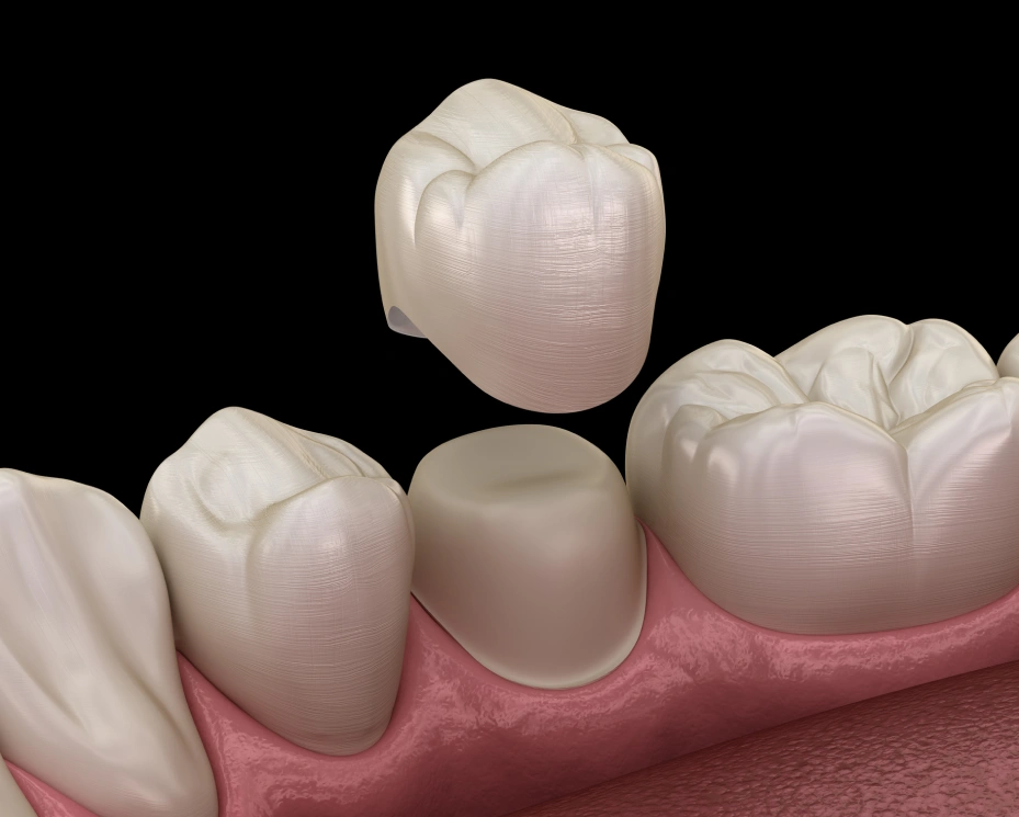 Restore Your Smile With Our Dental Crowns in Portland